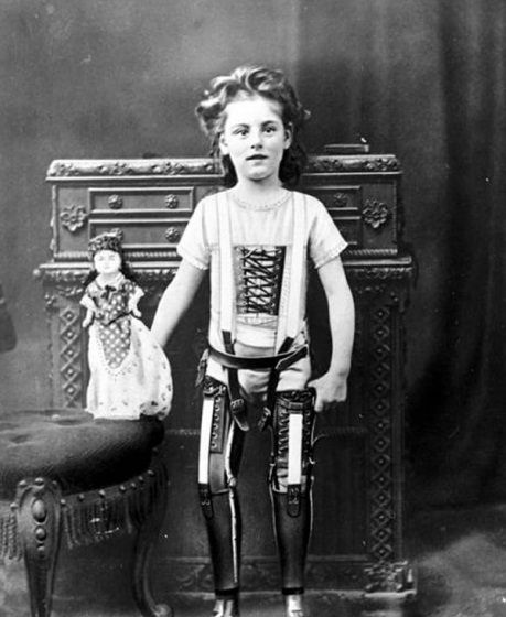 https://www.8monks.com/wp-content/uploads/2016/04/1898-1898-A-child-with-artificial-legs-.jpg